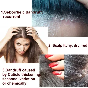 HORÚCE Šampón Starostlivosť o Vlasy Proti Lupinám Silné Antipruritic starostlivosť o Vlasy Vlasové Produkty Dermatitídy Vlasy, Lupiny Opravu Zdravotnej starostlivosti  5